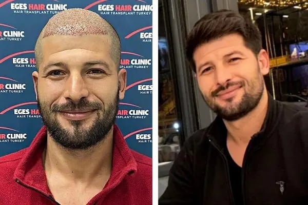 İzmir Saç Ekim Merkezi | Eges Hair Clinic - Resim 12