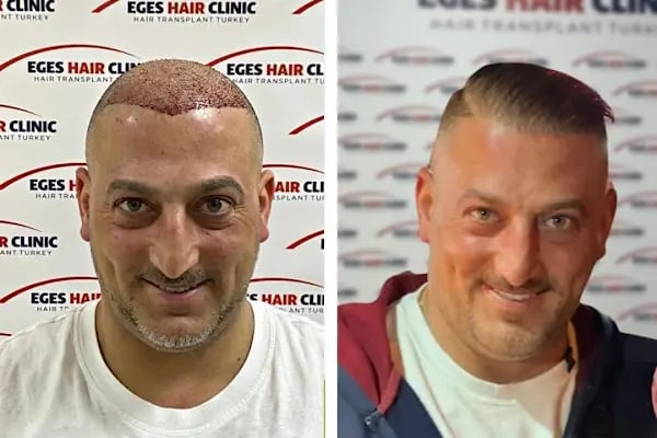 İzmir Saç Ekim Merkezi | Eges Hair Clinic - Resim 11
