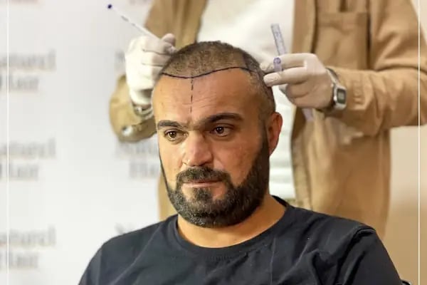 Trabzon Naturel Saç Ekim - Resim 4