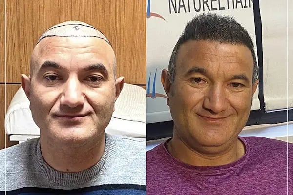 Trabzon Naturel Saç Ekim - Resim 10
