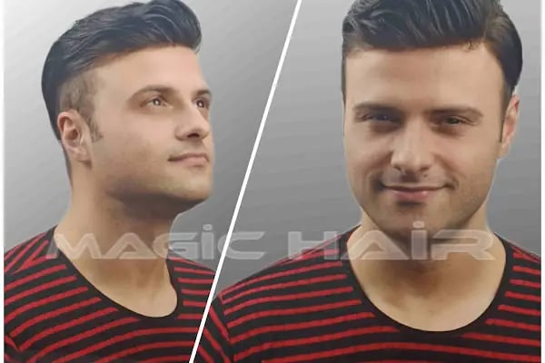 Magic Hair Protez Saç Merkezi - Resim 5