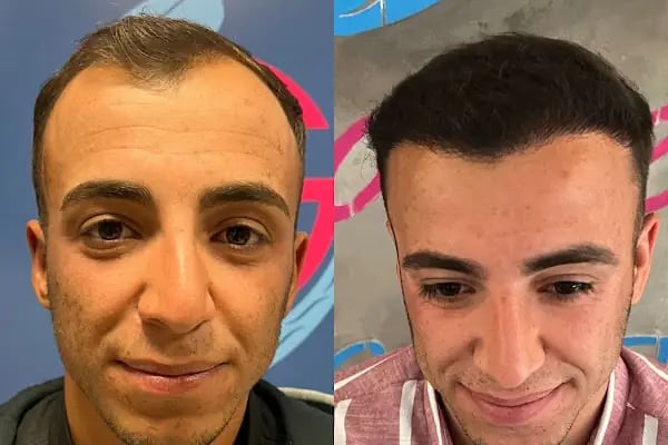 Gaziantep Hair Center(Gaziantep Saç Ekim Merkezi) - Resim 18