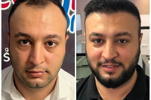 Gaziantep Hair Center(Gaziantep Saç Ekim Merkezi) - Resim 12