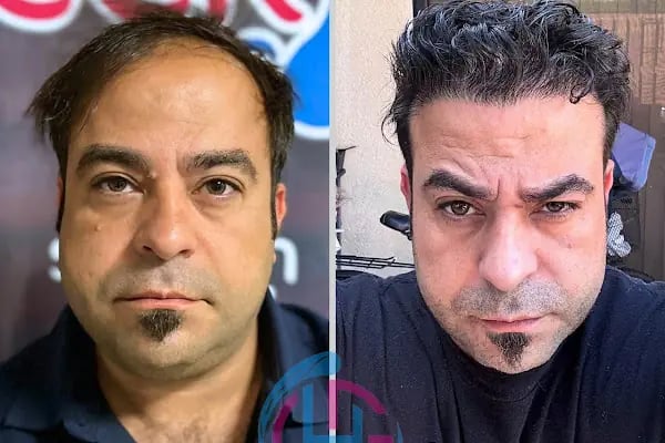 Gaziantep Hair Center(Gaziantep Saç Ekim Merkezi) - Resim 19