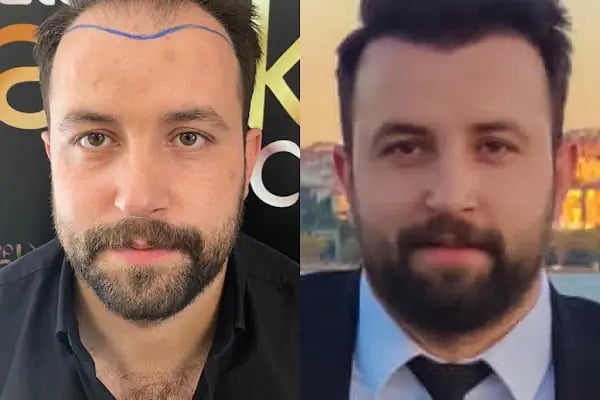 Gaziantep Hair Center(Gaziantep Saç Ekim Merkezi) - Resim 16
