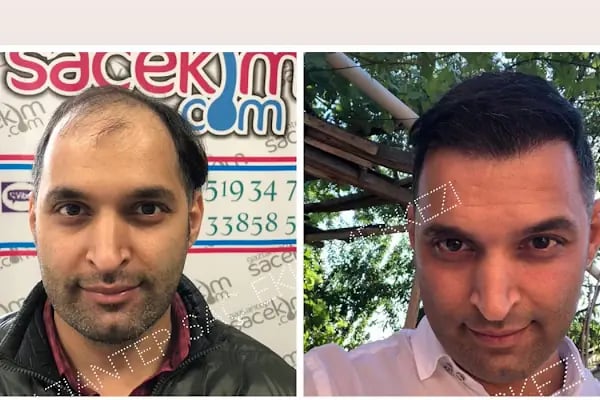 Gaziantep Hair Center(Gaziantep Saç Ekim Merkezi) - Resim 11