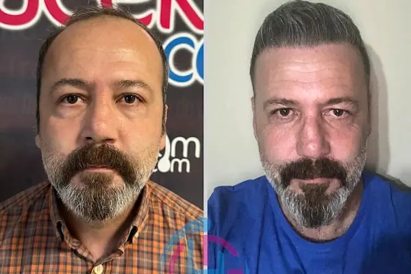 Gaziantep Hair Center(Gaziantep Saç Ekim Merkezi) - Resim 8