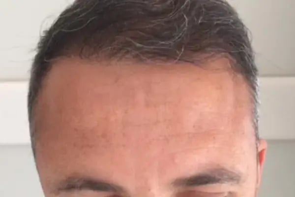 Trabzon Hair Transplant Center I مركز طرابزون لزراعة الشعر - Resim 6