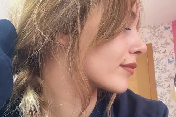 Burun Estetiği (Rinoplasti) Ankara Fiyatları - Op. Dr. Eda Çabuk Horoz, Kepçe Kulak, Göz Kapağı, Gamze Estetiği - Resim 11
