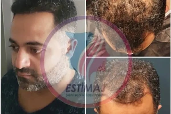 Estimaj Saç Ekim Merkezi - Resim 14