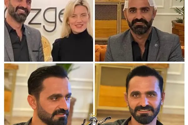 Özge Kara Saç Ekimi - Resim 20