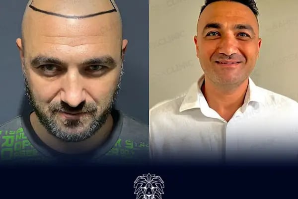 HAAREX CLİNİC SAÇ EKİM - HAİRTRANSPANT ANTALYA - Resim 4