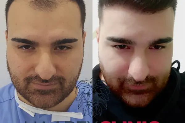 HAAREX CLİNİC SAÇ EKİM - HAİRTRANSPANT ANTALYA - Resim 18