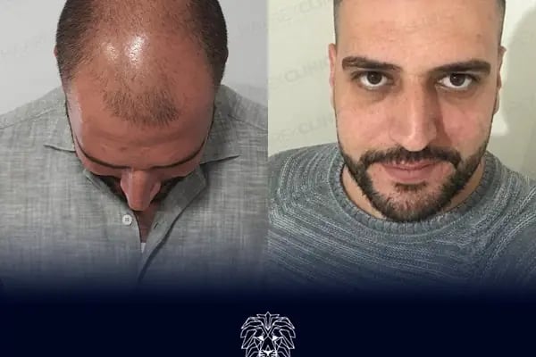 HAAREX CLİNİC SAÇ EKİM - HAİRTRANSPANT ANTALYA - Resim 6