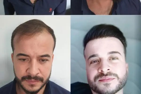 HAAREX CLİNİC SAÇ EKİM - HAİRTRANSPANT ANTALYA - Resim 17