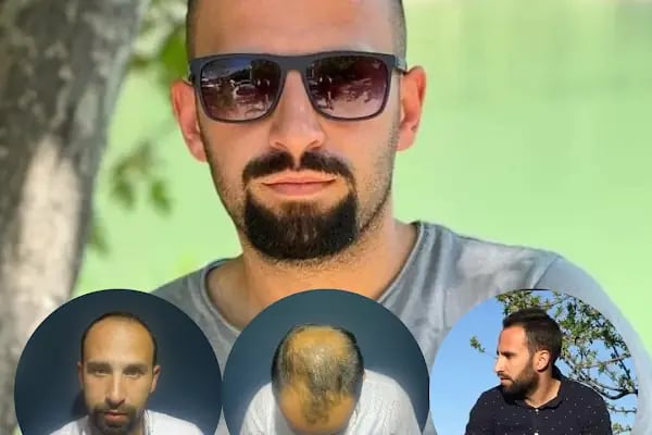 HAAREX CLİNİC SAÇ EKİM - HAİRTRANSPANT ANTALYA - Resim 14