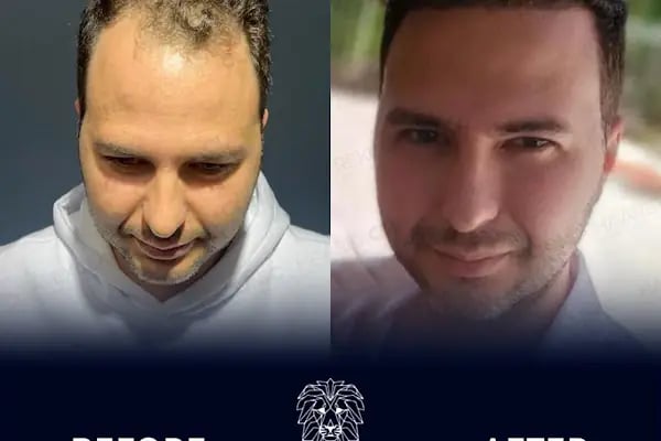 HAAREX CLİNİC SAÇ EKİM - HAİRTRANSPANT ANTALYA - Resim 7