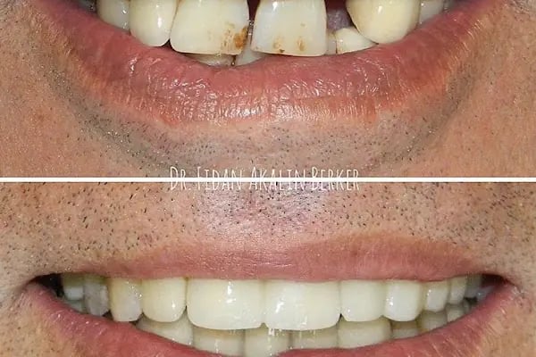 Diş Hekimi Protez Uzmanı Dr. Fidan AKALIN BERKER Ataşehir İstanbul - Resim 16