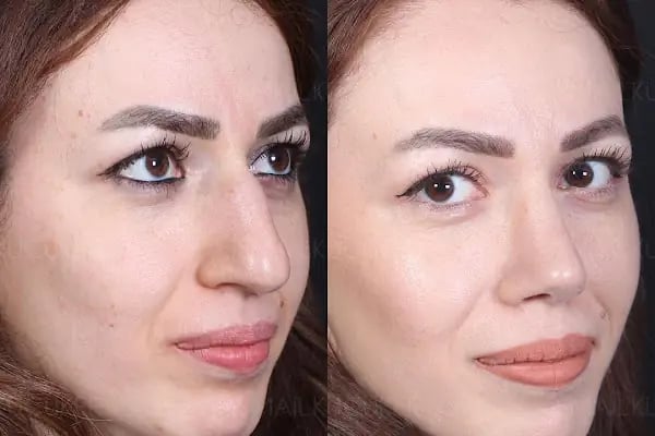 Prof.Dr.İsmail Küçüker - Burun Estetiği - Botoks - EmSculpt Neo - Emtone - Resim 19