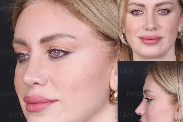 Prof.Dr.İsmail Küçüker - Burun Estetiği - Botoks - EmSculpt Neo - Emtone - Resim 20