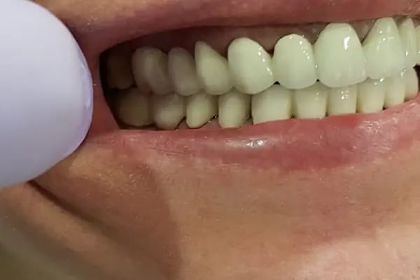 İstanbul bağcılar güngören bahçelievler acil diş estetica - Resim 1