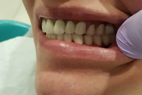 İstanbul bağcılar güngören bahçelievler acil diş estetica - Resim 2