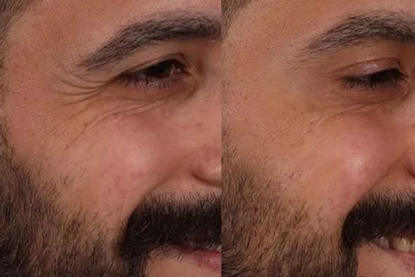 Estetik Bodrum | Dudak Dolgusu | Botoks | PRP | Mezoterapi | İp Askı | Cilt Bakımı | Gençlik Aşısı - Resim 6
