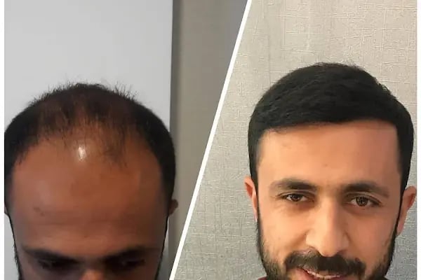 Mersin Rana Saç Ekim Merkezi - Resim 5