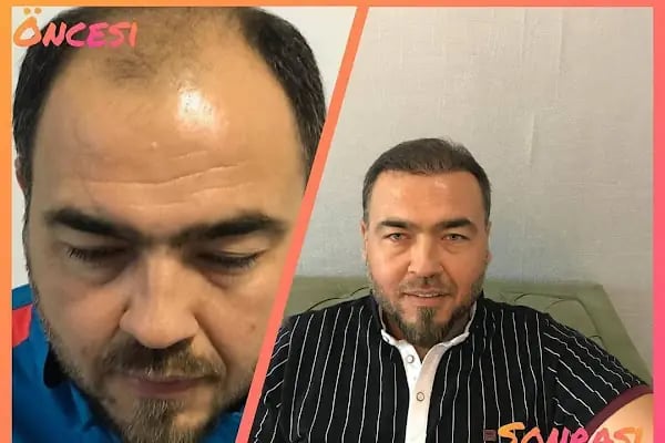 Mersin Rana Saç Ekim Merkezi - Resim 4