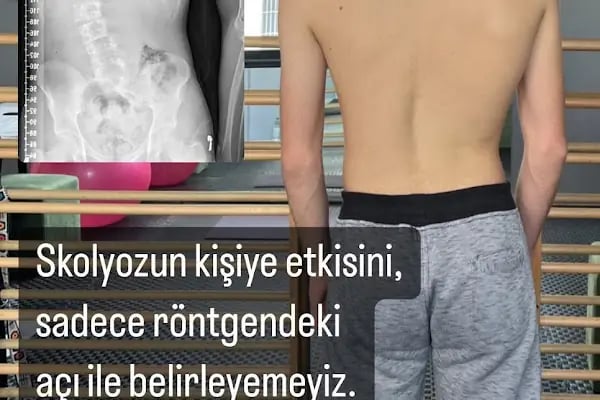 Uzm. Fzt. Berkay Tutar - Adana Skolyoz Merkezi - Resim 20