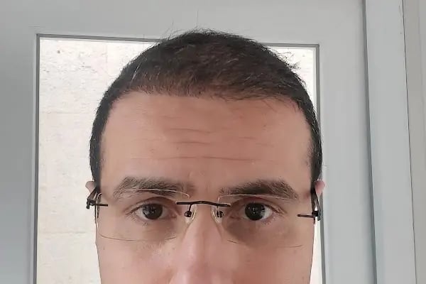 Avicenna Hastanesi Saç Ekim Merkezi - Resim 14