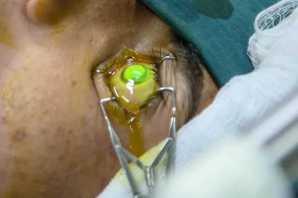 Op. Dr. Berkant Bozdağ | Katarakt Ameliyatı | Akıllı Lens | No Touch Lazer | Göz Kapağı Estetiği İstanbul - Resim 5