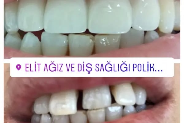 Bursa Elit Ağız ve Diş Sağlığı Polikliniği - Resim 17