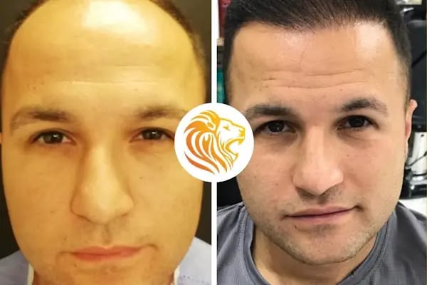 Op. Dr. Ali Dursun KAN PLASTİK ESTETİK VE REKONSTRİKTİF CERRAHİ&amp;GENEL CERRAHİ&amp;SAÇ EKİMİ - Resim 7