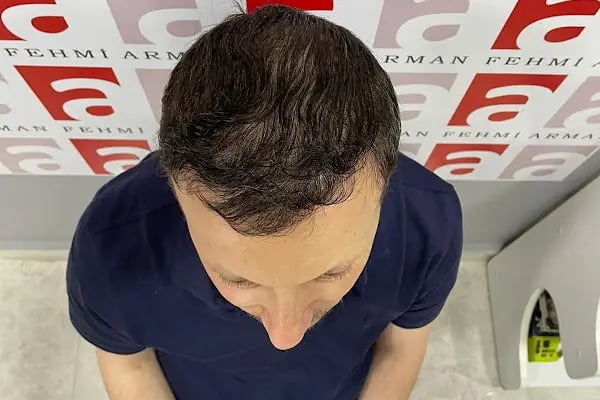 Fehmi ARMAN Health hair Tourism - Resim 18