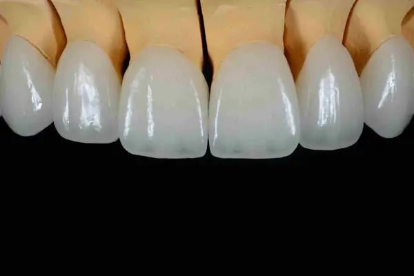 Diş Hekimi Protez Uzmanı. Dr. Dt. Esat Başol, Gülüş Tasarımı ve İmplant Klinikleri. İmplant/ Zirkonyum/ Estetik Diş Hekimliği - Resim 9