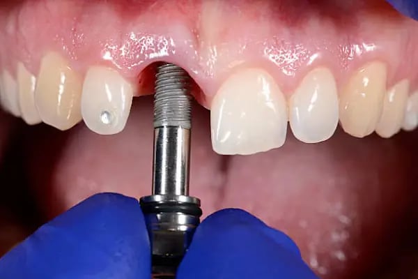 Uzm.Dr. Berk EROL | Çene Cerrahisi ve İmplant Kliniği - Resim 8