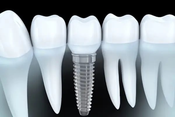 Uzm.Dr. Berk EROL | Çene Cerrahisi ve İmplant Kliniği - Resim 4