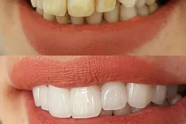 Estetica Dent all safa hast.yan sokağı bağcılar acil diş zirkon Safa diş - Resim 10
