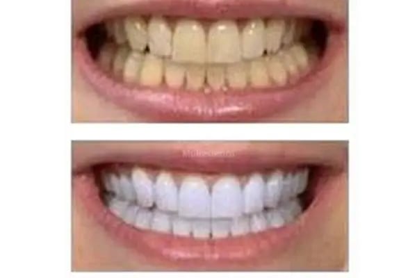 Estetica Dent all safa hast.yan sokağı bağcılar acil diş zirkon Safa diş - Resim 15