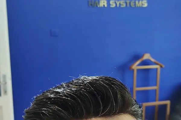 Aurahair protez saç merkezi - Resim 5