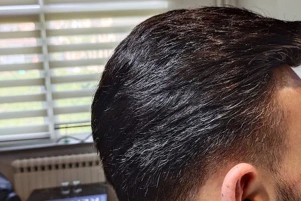 Aurahair protez saç merkezi - Resim 13