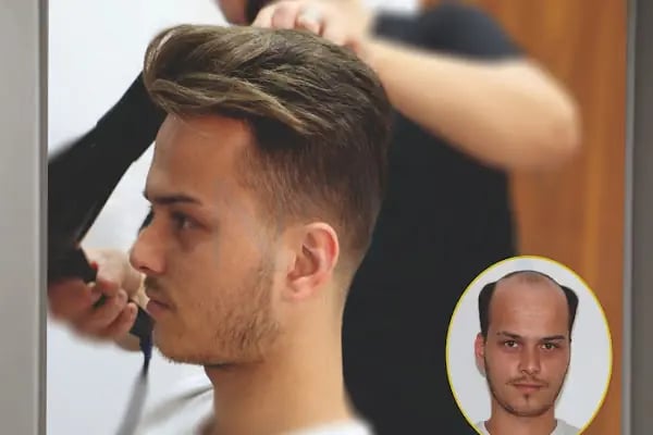 Aurahair protez saç merkezi - Resim 10