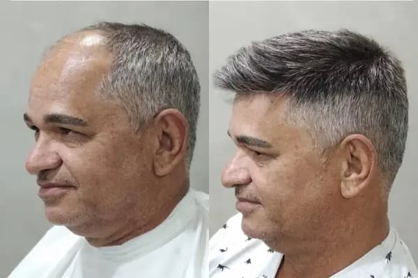 Aurahair protez saç merkezi - Resim 17