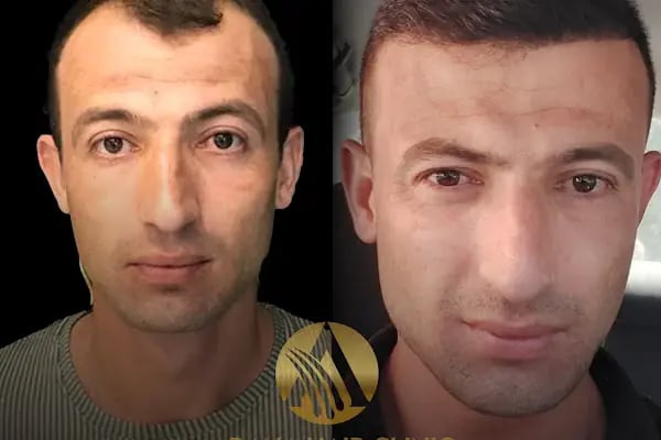 Simya Saç Ekimi &amp; Güzellik Merkezi - Hair Transplant Clinic in Turkey - Resim 20