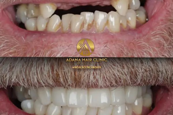 Simya Saç Ekimi &amp; Güzellik Merkezi - Hair Transplant Clinic in Turkey - Resim 8