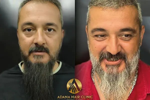 Simya Saç Ekimi &amp; Güzellik Merkezi - Hair Transplant Clinic in Turkey - Resim 4