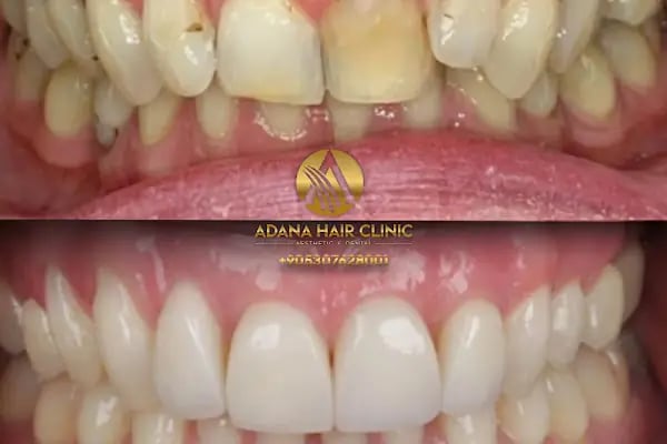 Simya Saç Ekimi &amp; Güzellik Merkezi - Hair Transplant Clinic in Turkey - Resim 19