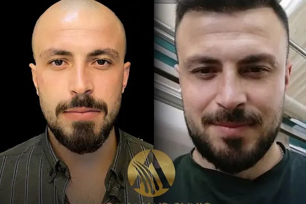 Simya Saç Ekimi &amp; Güzellik Merkezi - Hair Transplant Clinic in Turkey - Resim 5