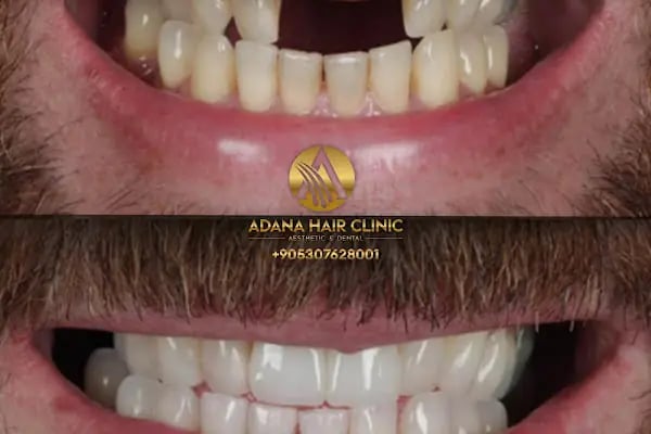 Simya Saç Ekimi &amp; Güzellik Merkezi - Hair Transplant Clinic in Turkey - Resim 18